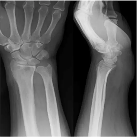 X-ray Left Wrist AP Lateral
